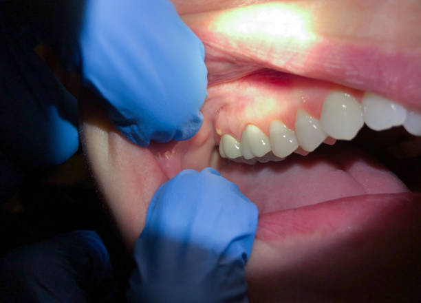 Best Emergency Cosmetic Dentistry (e.g., broken veneers) in Camp Wood, TX